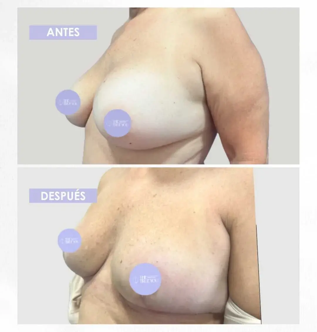 Best plastic surgery in Medellin Colombia- Dra. Daniela Correa- Before and after Breast Surgery