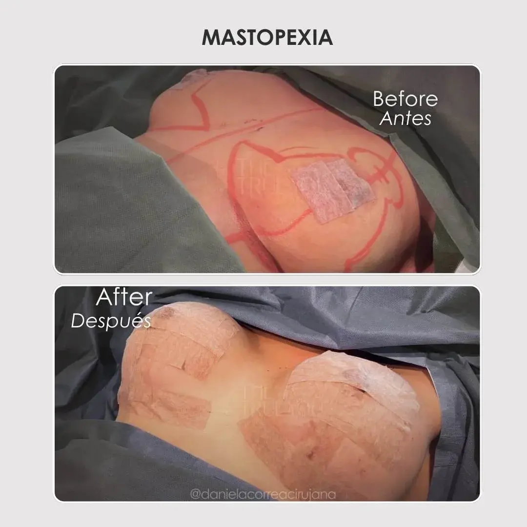 Best plastic surgery in Medellin Colombia- Dra. Daniela Correa- Before and after Breast Surgery