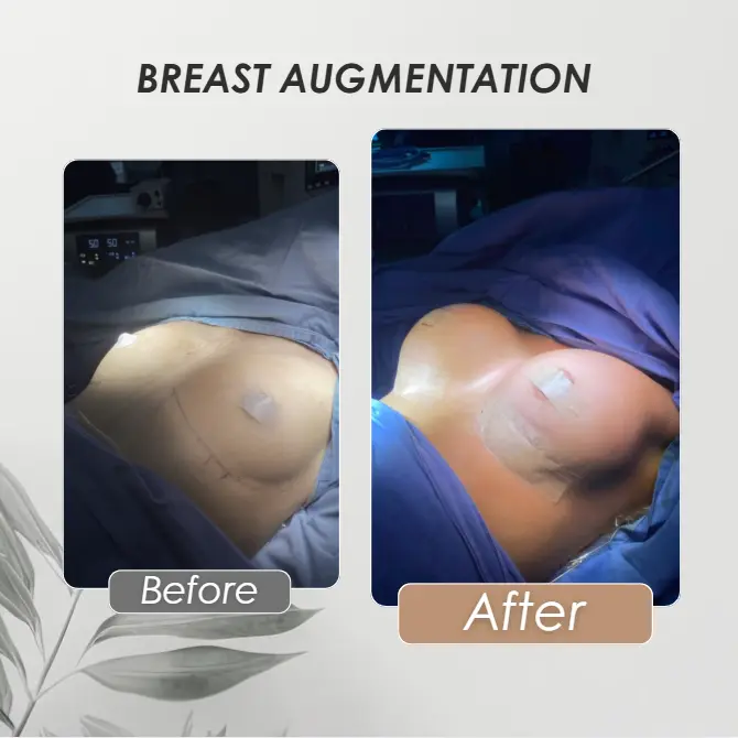 Best plastic surgery in Medellin Colombia- Dra. Daniela Correa- Before and after Breast augmentation