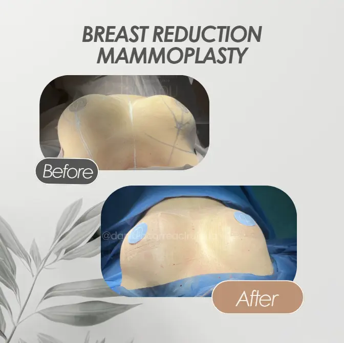 Best plastic surgery in Medellin Colombia- Dra. Daniela Correa- Before and after Breast reduction mammoplasty