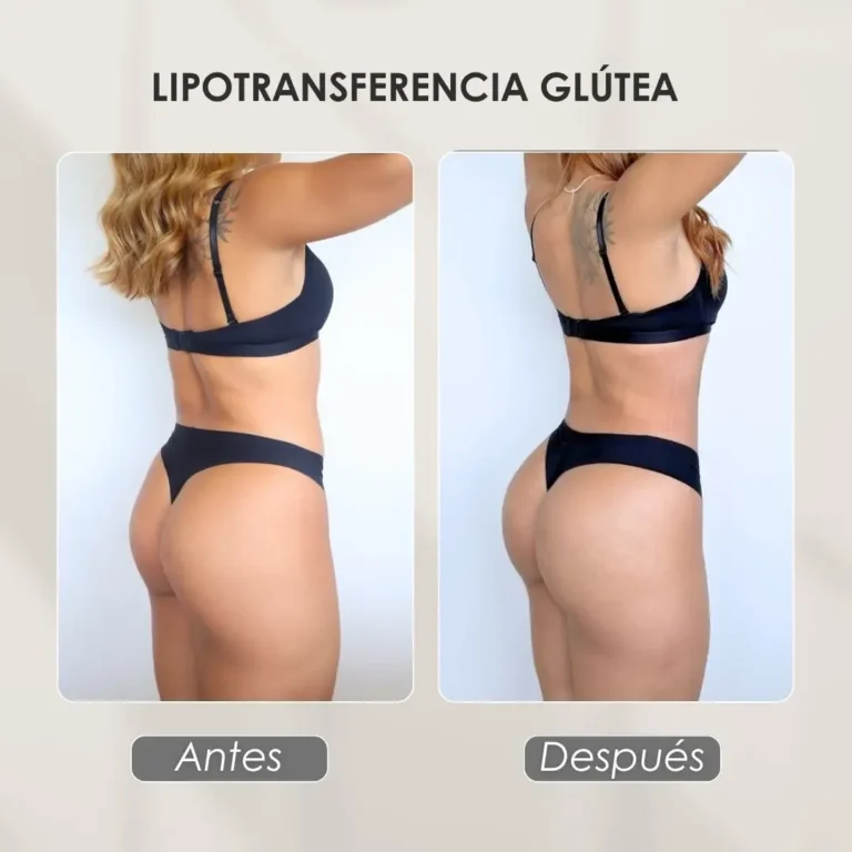 Best plastic surgery in Medellin Colombia- Dra. Daniela Correa- Before and after Gluteoplasty