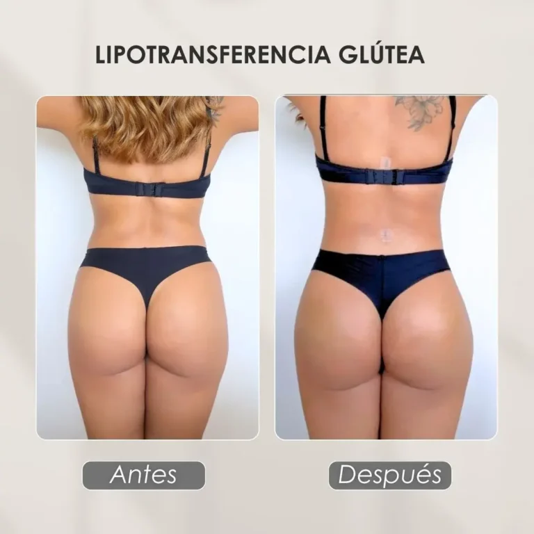 Best plastic surgery in Medellin Colombia- Dra. Daniela Correa- Before and after Gluteoplasty