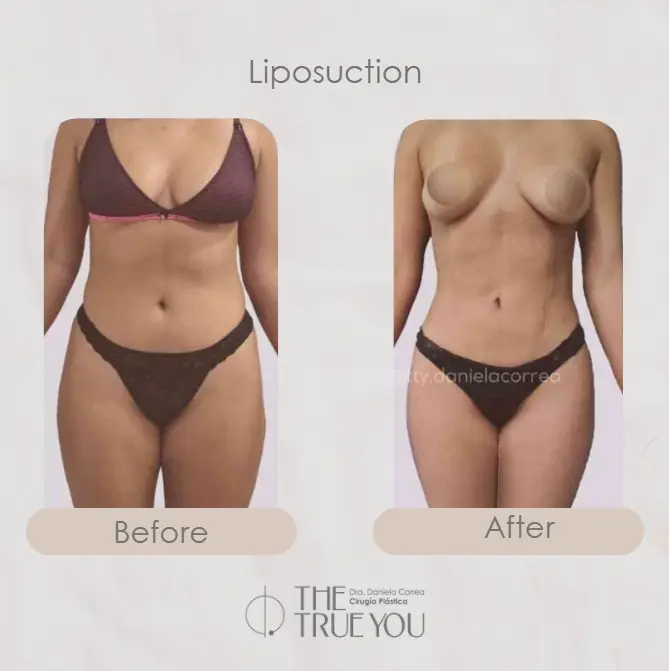 Best plastic surgery in Medellin Colombia- Dra. Daniela Correa- Before and after Liposuction