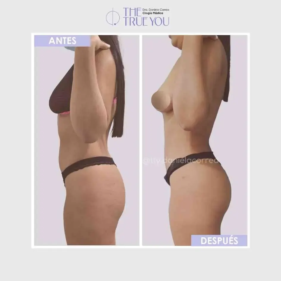 Best plastic surgery in Medellin Colombia- Dra. Daniela Correa- Before and after Liposuction