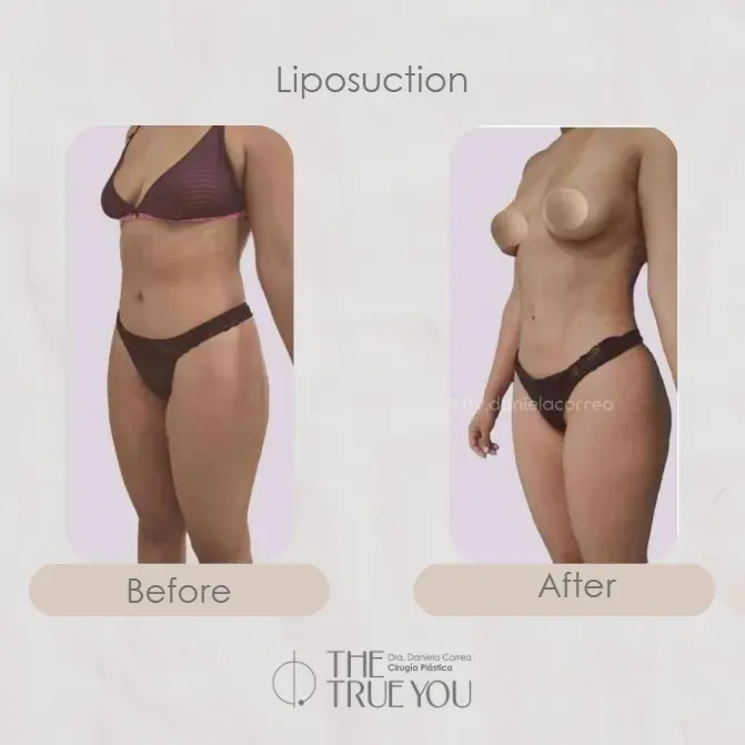 Best plastic surgery in Medellin Colombia- Dra. Daniela Correa- Before and after Liposuction