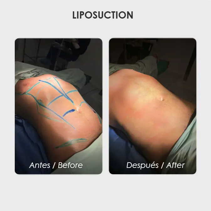 Best plastic surgery in Medellin Colombia- Dra. Daniela Correa- Before and after Liposuction