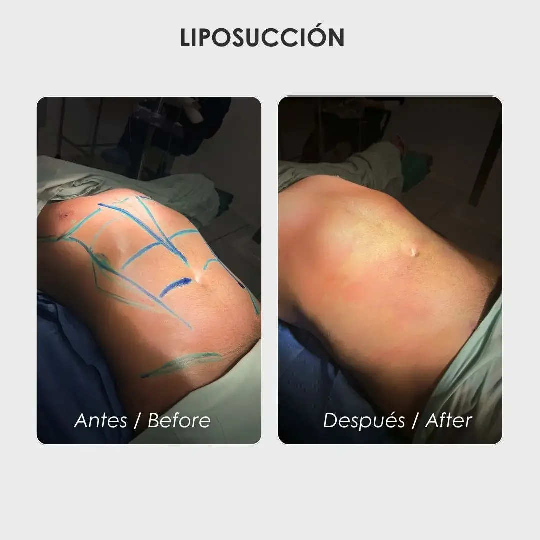 Best plastic surgery in Medellin Colombia- Dra. Daniela Correa- Before and after Liposuction