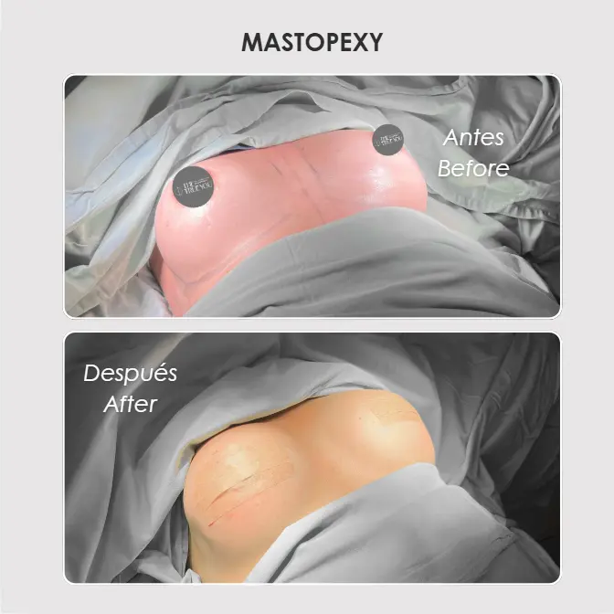 Best plastic surgery in Medellin Colombia- Dra. Daniela Correa- Before and after Mastopexi