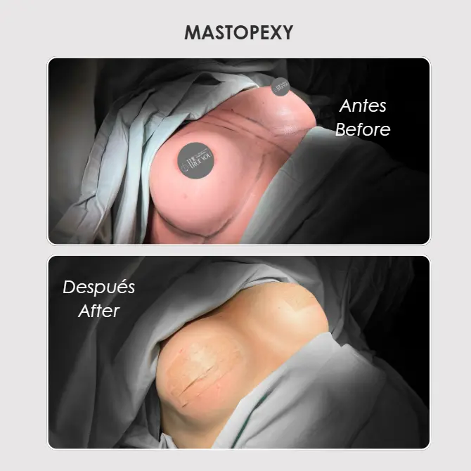 Best plastic surgery in Medellin Colombia- Dra. Daniela Correa- Before and after Mastopexi