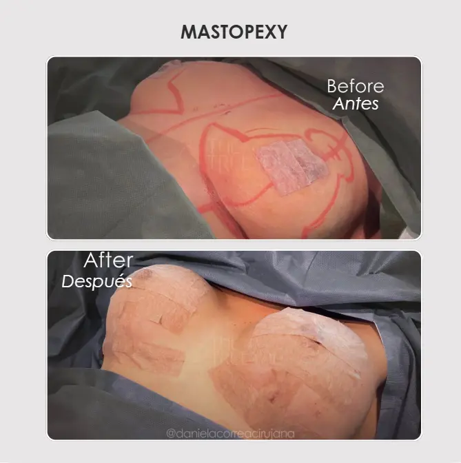 Best plastic surgery in Medellin Colombia- Dra. Daniela Correa- Before and after Mastopexi