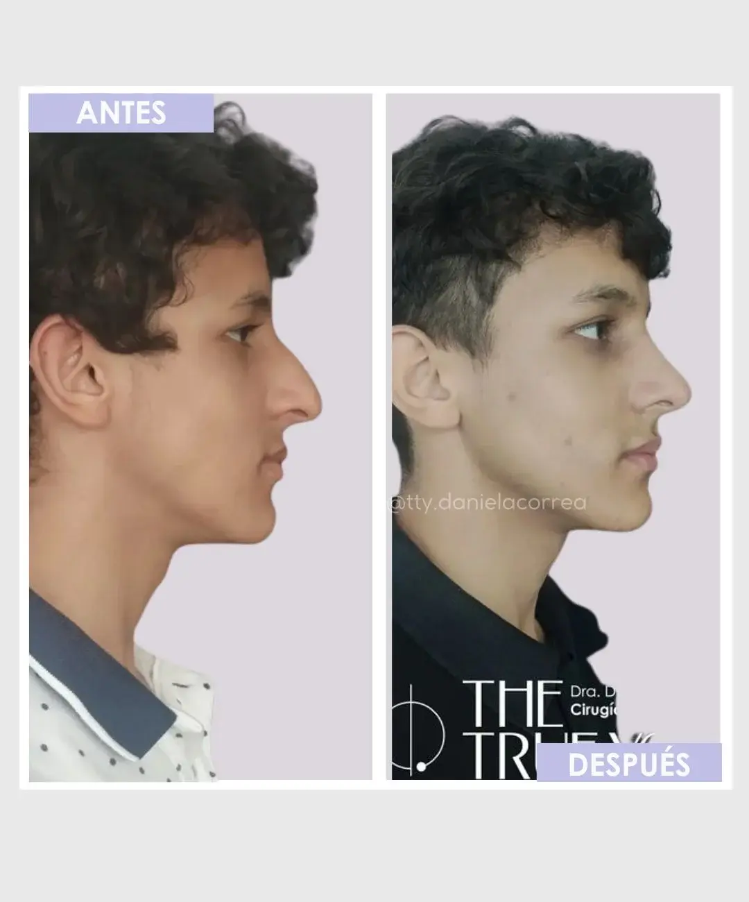 Best plastic surgery in Medellin Colombia- Dra. Daniela Correa- Before and after Rhinoplasty