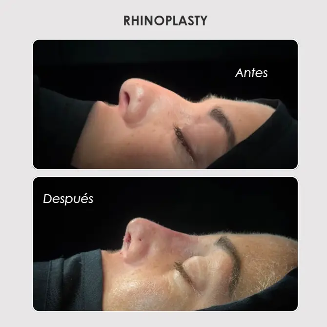 Best plastic surgery in Medellin Colombia- Dra. Daniela Correa- Before and after Rhinoplasty Medellín