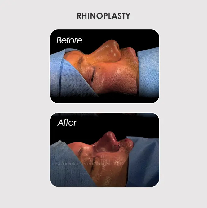 Best plastic surgery in Medellin Colombia- Dra. Daniela Correa- Before and after Rhinoplasty Medellín