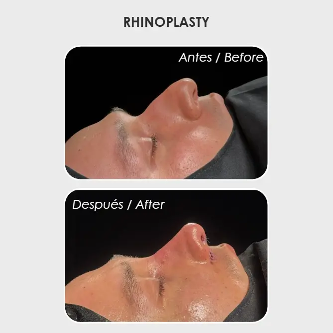 Best plastic surgery in Medellin Colombia- Dra. Daniela Correa- Before and after Rhinoplasty Medellín