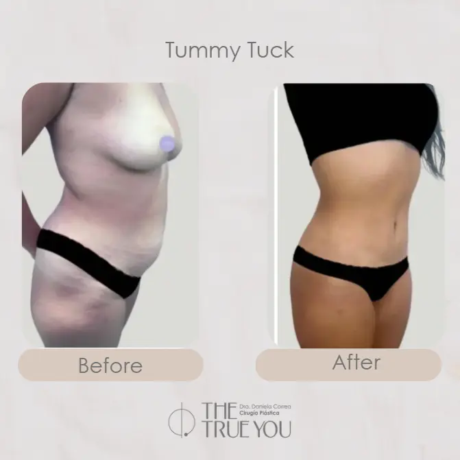 Best plastic surgery in Medellin Colombia- Dra. Daniela Correa- Before and after Tummy Tuck