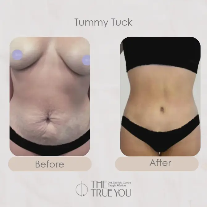 Best plastic surgery in Medellin Colombia- Dra. Daniela Correa- Before and after Tummy Tuck