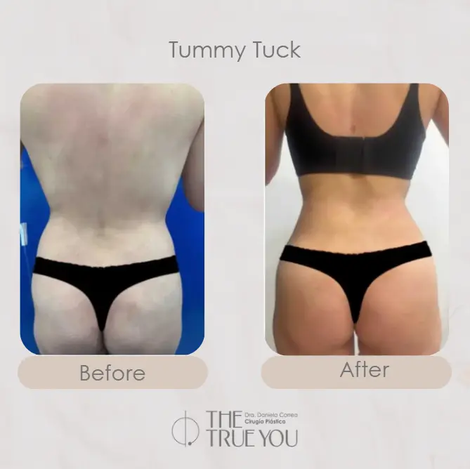 Best plastic surgery in Medellin Colombia- Dra. Daniela Correa- Before and after Tummy Tuck