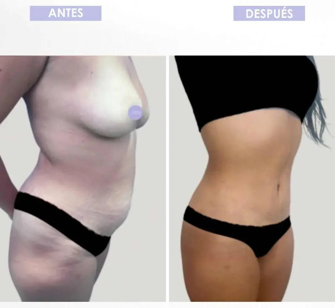 Best plastic surgery in Medellin Colombia- Dra. Daniela Correa- Before and after Tummy Tuck