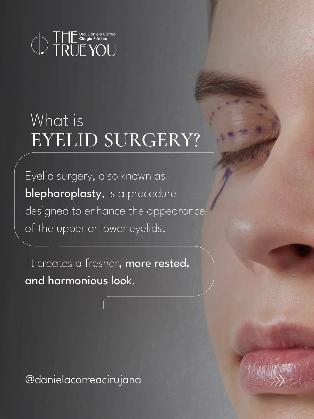 Blepharoplasty in Colombia