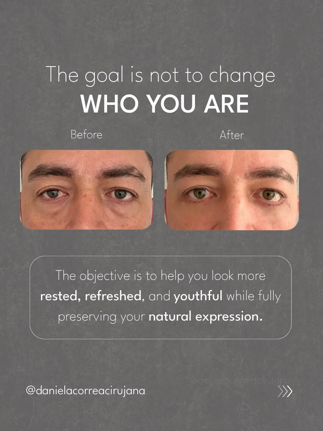 Eyelid Surgery in Colombia- What International Patients Should Know