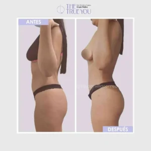 Lipoabdominoplastia en Medellín- Dra. Daniela Correa