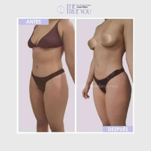 Lipoabdominoplastia en Medellín- Dra. Daniela Correa