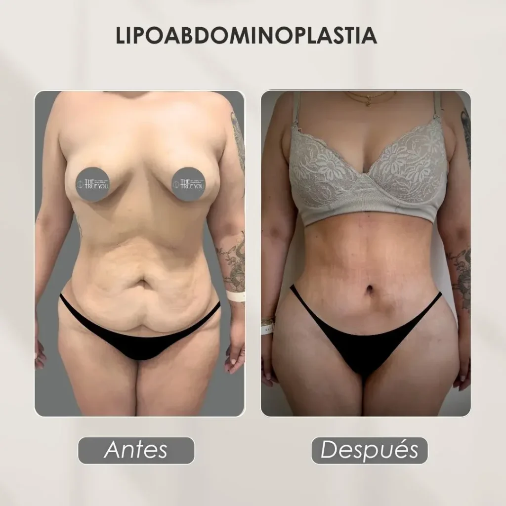 Lipoabdominoplastia en Medellín- Dra. Daniela Correa