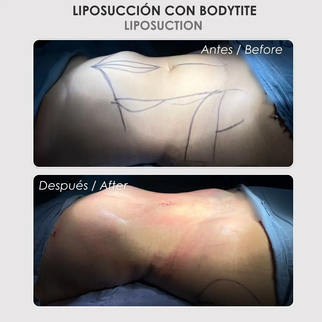 Liposucción con bodytite antes y después - Cirujana plástica de Medellín, Colombia, Daniela Correa -- 040826