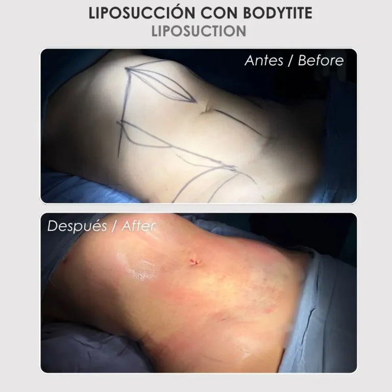 Liposucción con bodytite antes y después - Cirujana plástica de Medellín colombia Daniela Correa - 040826