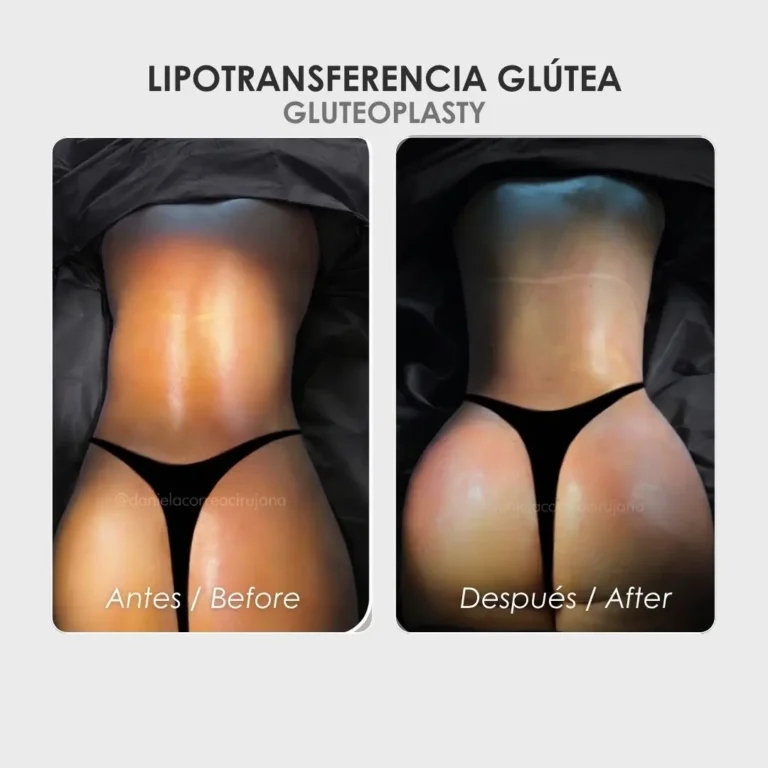 Lipotransferencia glútea antes y después - Cirujana plástica de Medellín colombia Daniela Correa - 040826