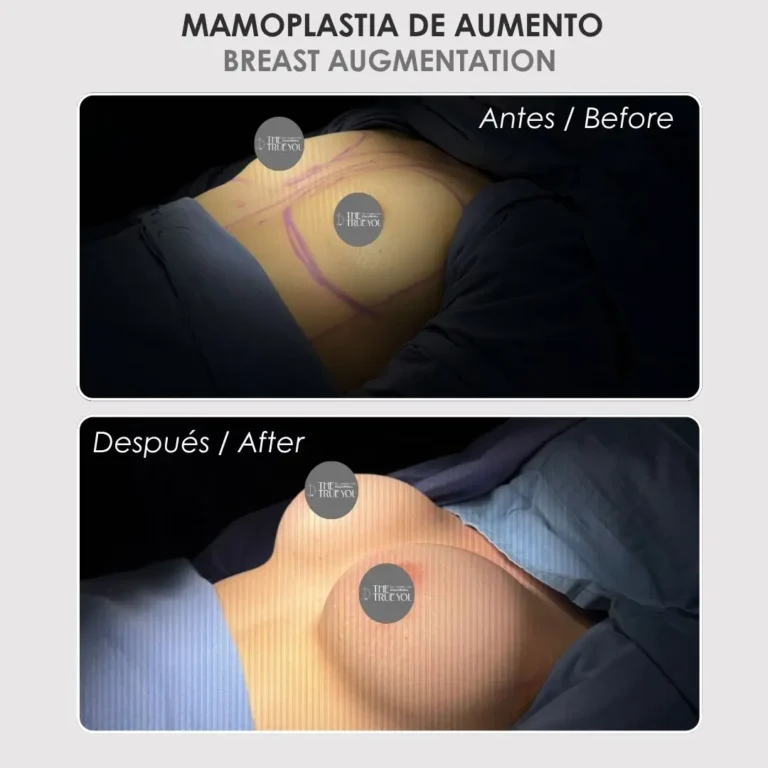 Mamoplastia de aumento antes y después - Cirujana plástica de Medellín colombia Daniela Correa - 040826 1