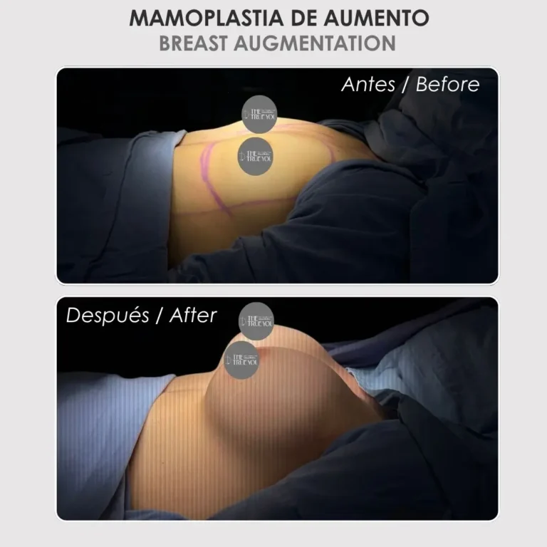 Mamoplastia de aumento antes y después - Cirujana plástica de Medellín colombia Daniela Correa - 040826