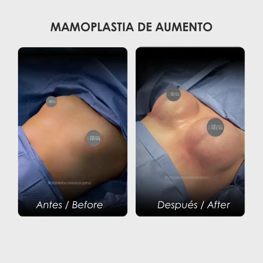 Tipos de implantes de senos- Dra. Daniela Correa en Medellín- Antes y después