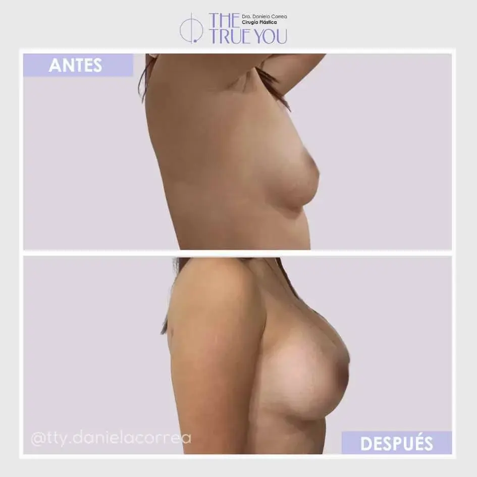 Tipos de implantes de senos- Dra. Daniela Correa en Medellín- Antes y después