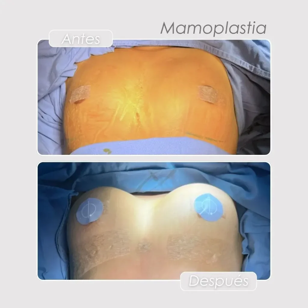 Tipos de implantes de senos- Dra. Daniela Correa en Medellín- Antes y después