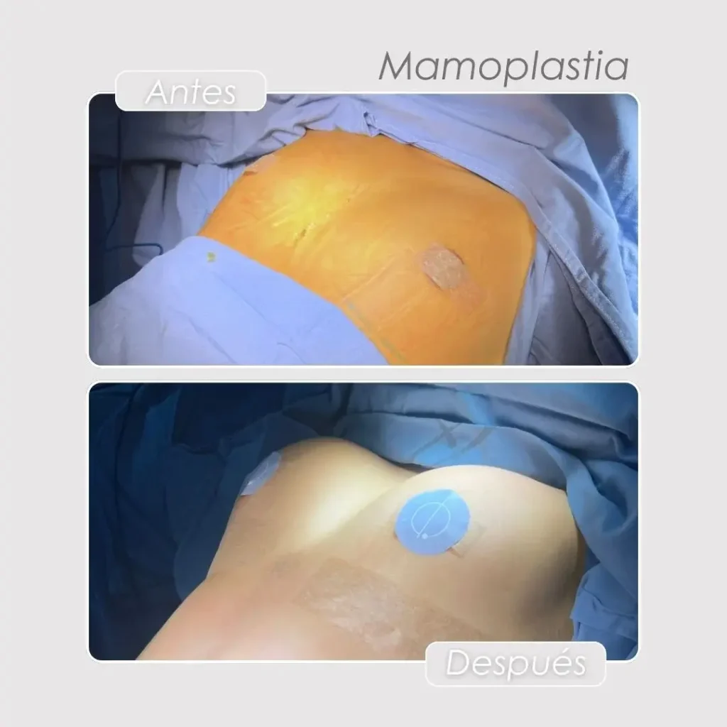 Tipos de implantes de senos- Dra. Daniela Correa en Medellín- Antes y después