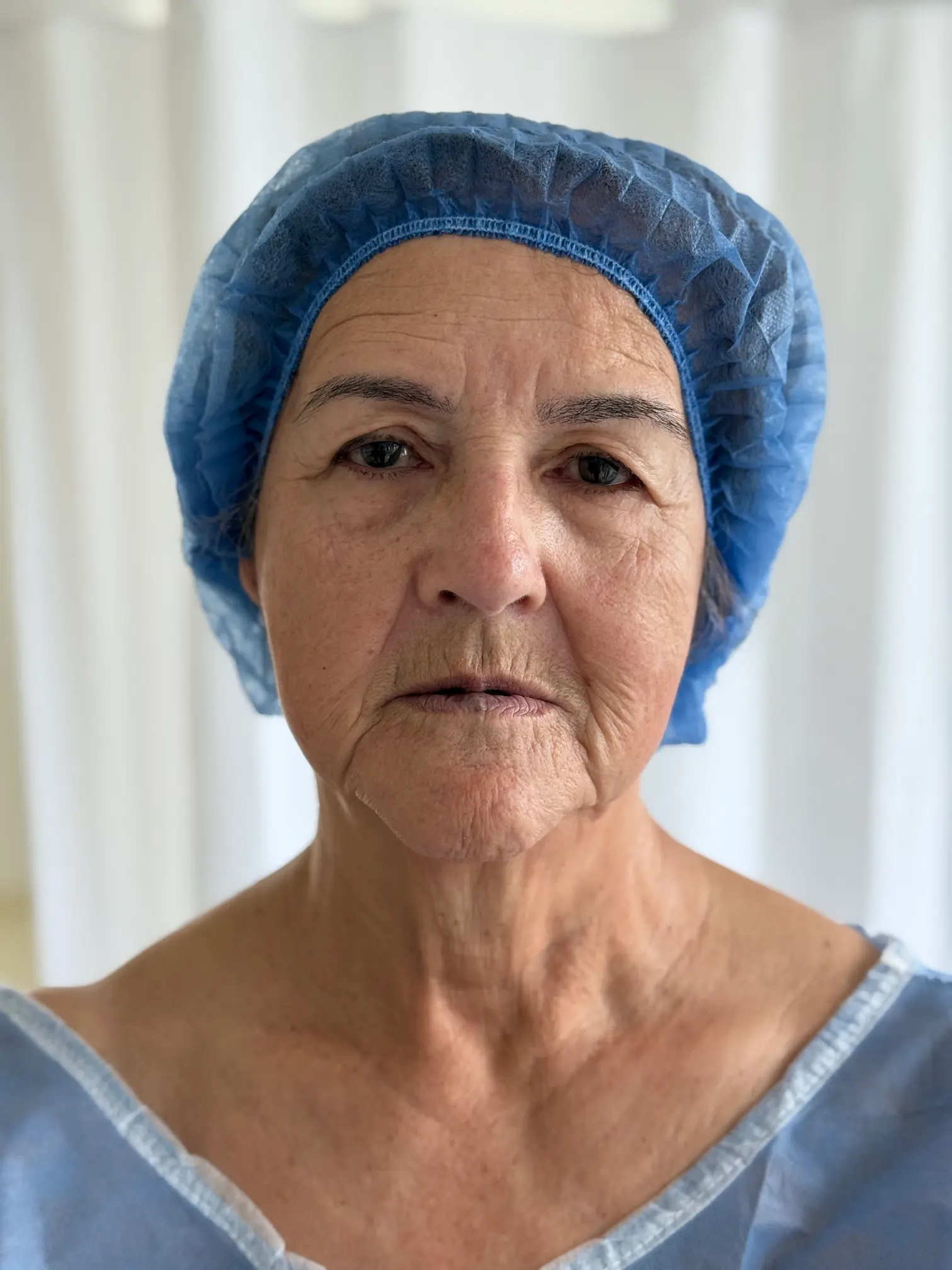 Antes de blefaroplastia superior e inferior en paciente real - Daniela Correa - Medellín, Colombia