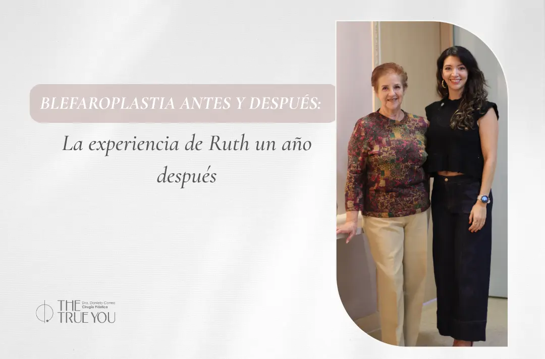 Blefaroplastia antes y después - La experiencia de Ruth un año después de su cirugía con la Dra. Daniela Correa en Medellín, Colombia