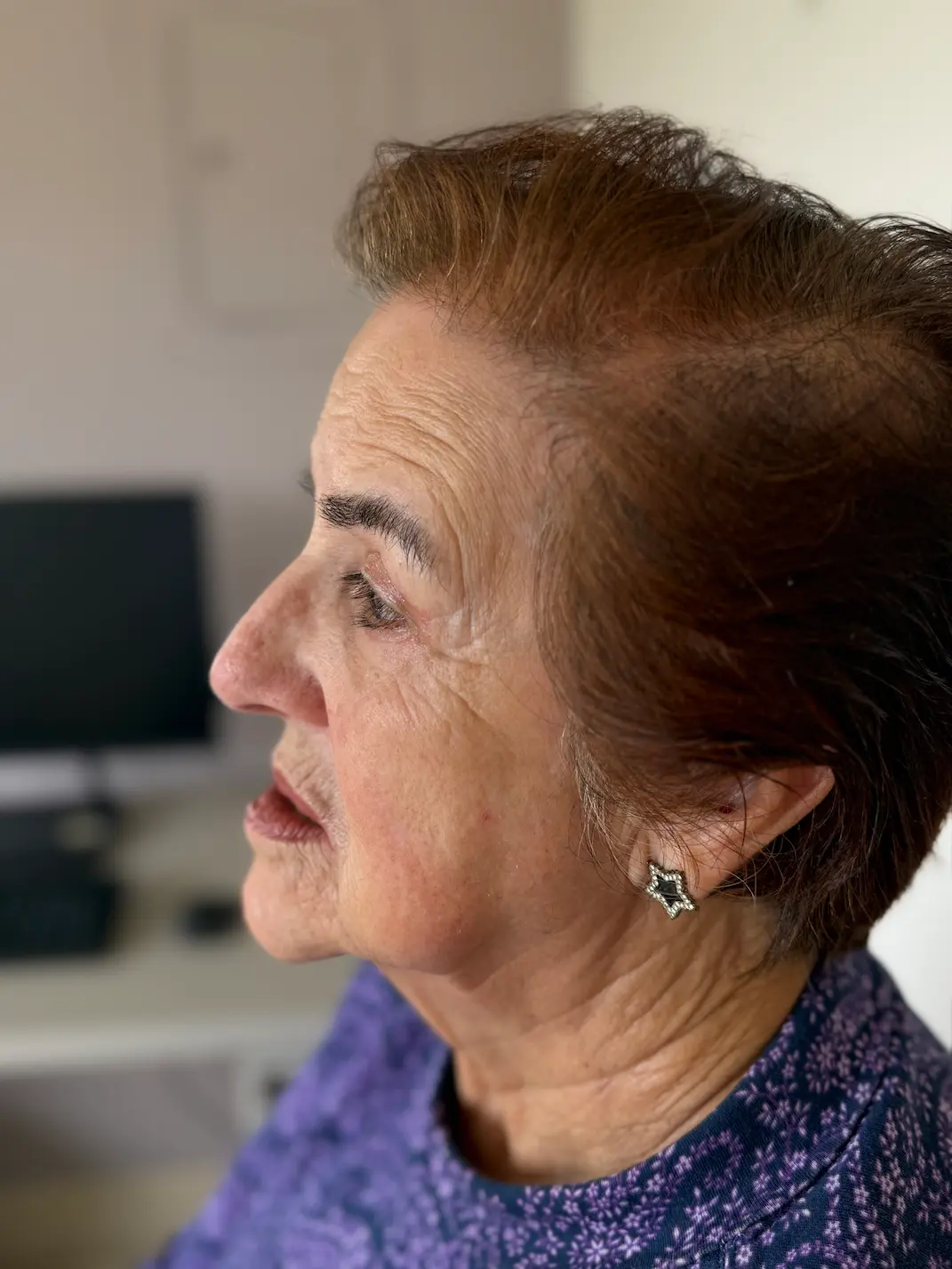Blefaroplastia antes y después resultado natural tras un año - Dra. Daniela Correa - Medellín, Colombia