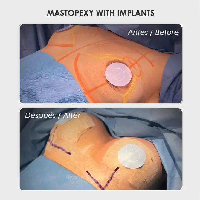 Breast Lift Colombia before and after- Dr. Daniela Correa- Plastic surgery in Medellín
