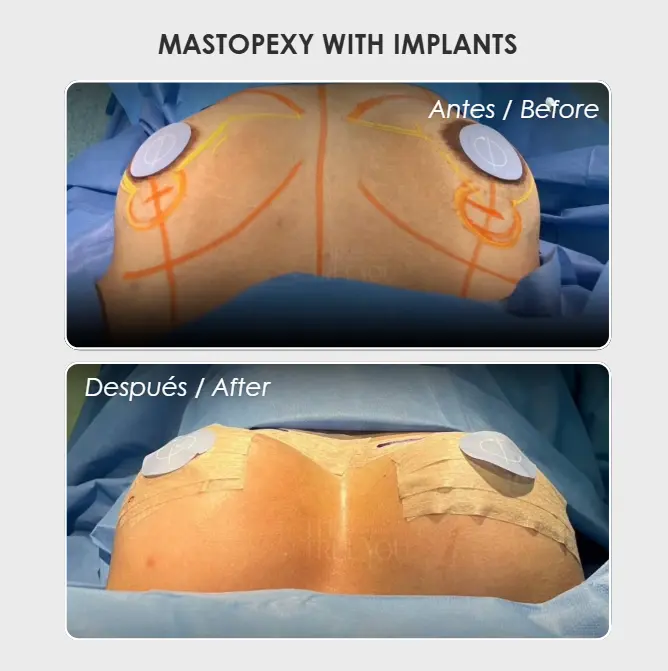 Breast Lift Colombia before and after- Dr. Daniela Correa- Plastic surgery in Medellín