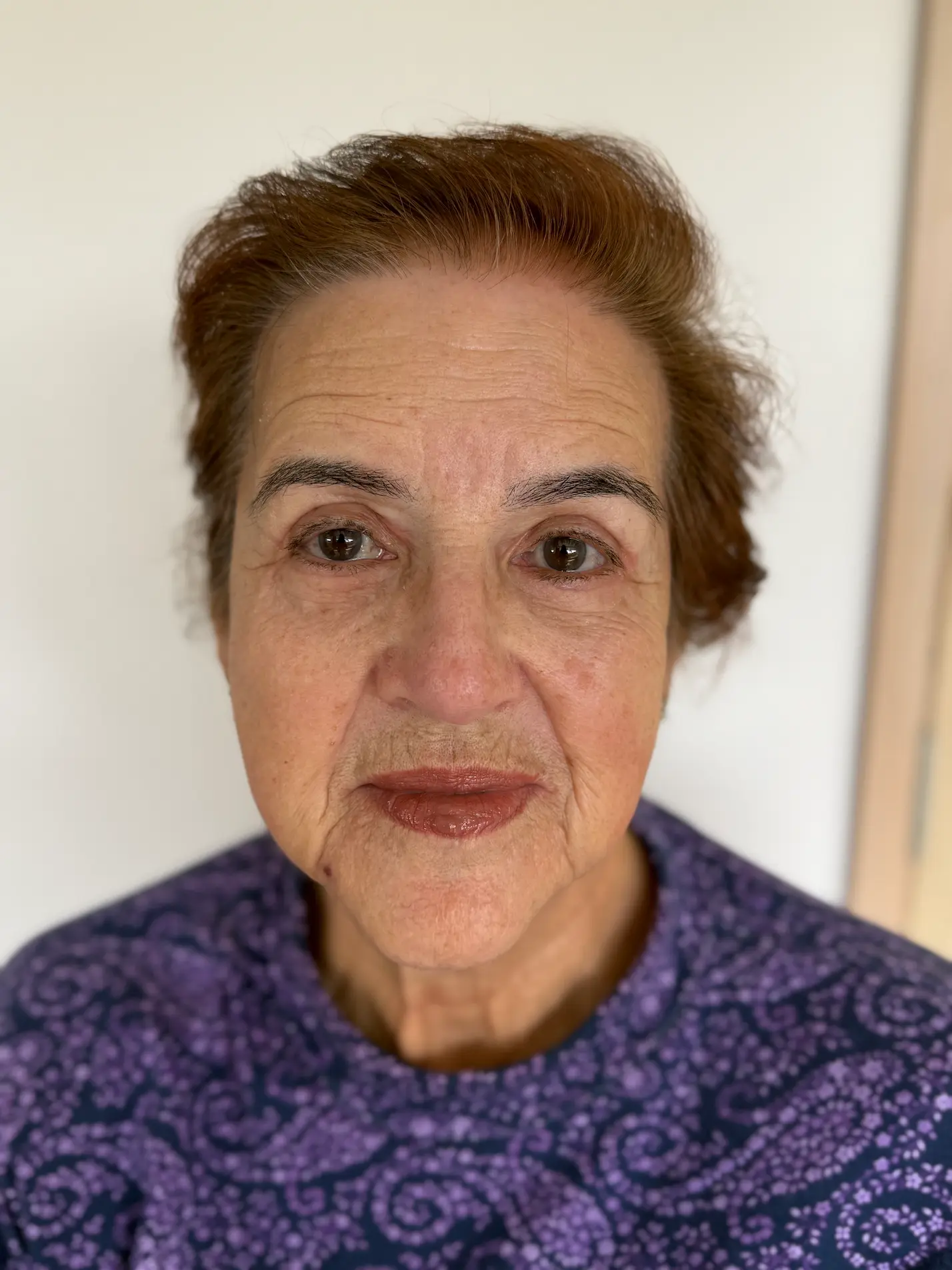 Después de blefaroplastia superior e inferior en paciente real - Dra. Daniela Correa - Medellín, Colombia