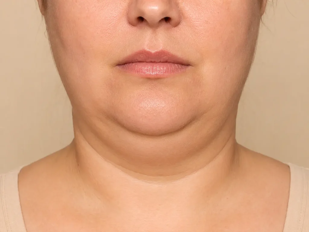 Más allá de los años: ¿cómo saber cuál es la edad ideal para una cirugía plástica? - Lipopapada - Dra Daniela Correa