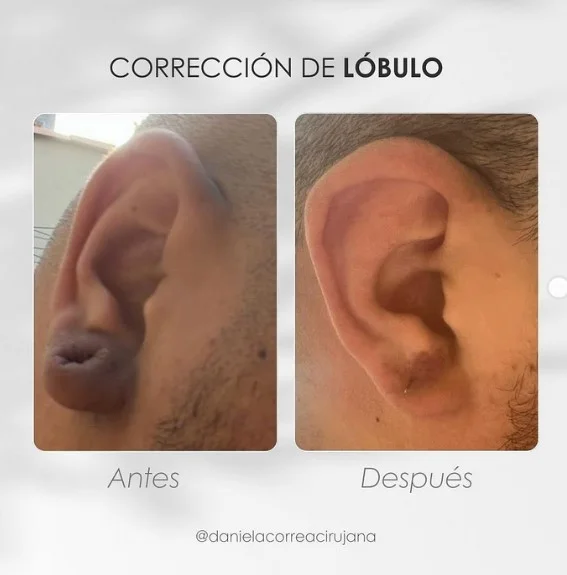 Lobuloplastia-cicatriz-antes-y-despues-Dra.-Daniela-Correa-cirujana-plastica-en-Medellin
