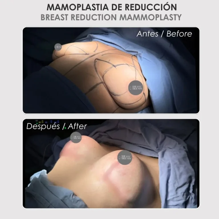 Mamoplastia de reducción antes y después - Cirujana plástica de Medellín colombia Daniela Correa - 020926 2