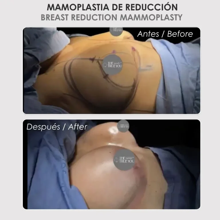 Mamoplastia de reducción antes y después - Cirujana plástica de Medellín colombia Daniela Correa - 020926