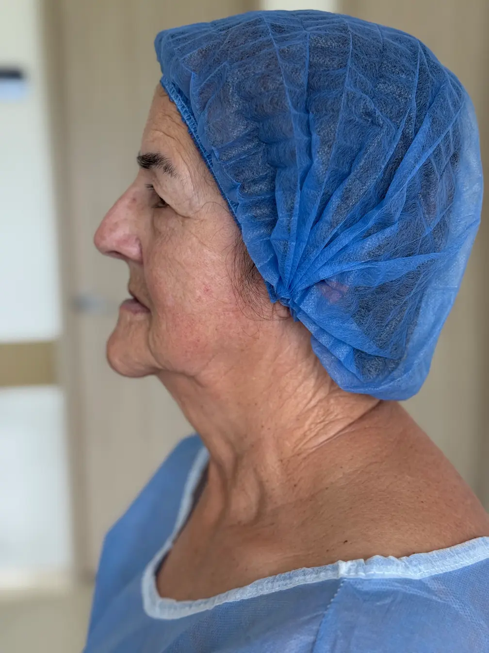 Mirada de paciente antes de blefaroplastia con la Dra. Daniela Correa