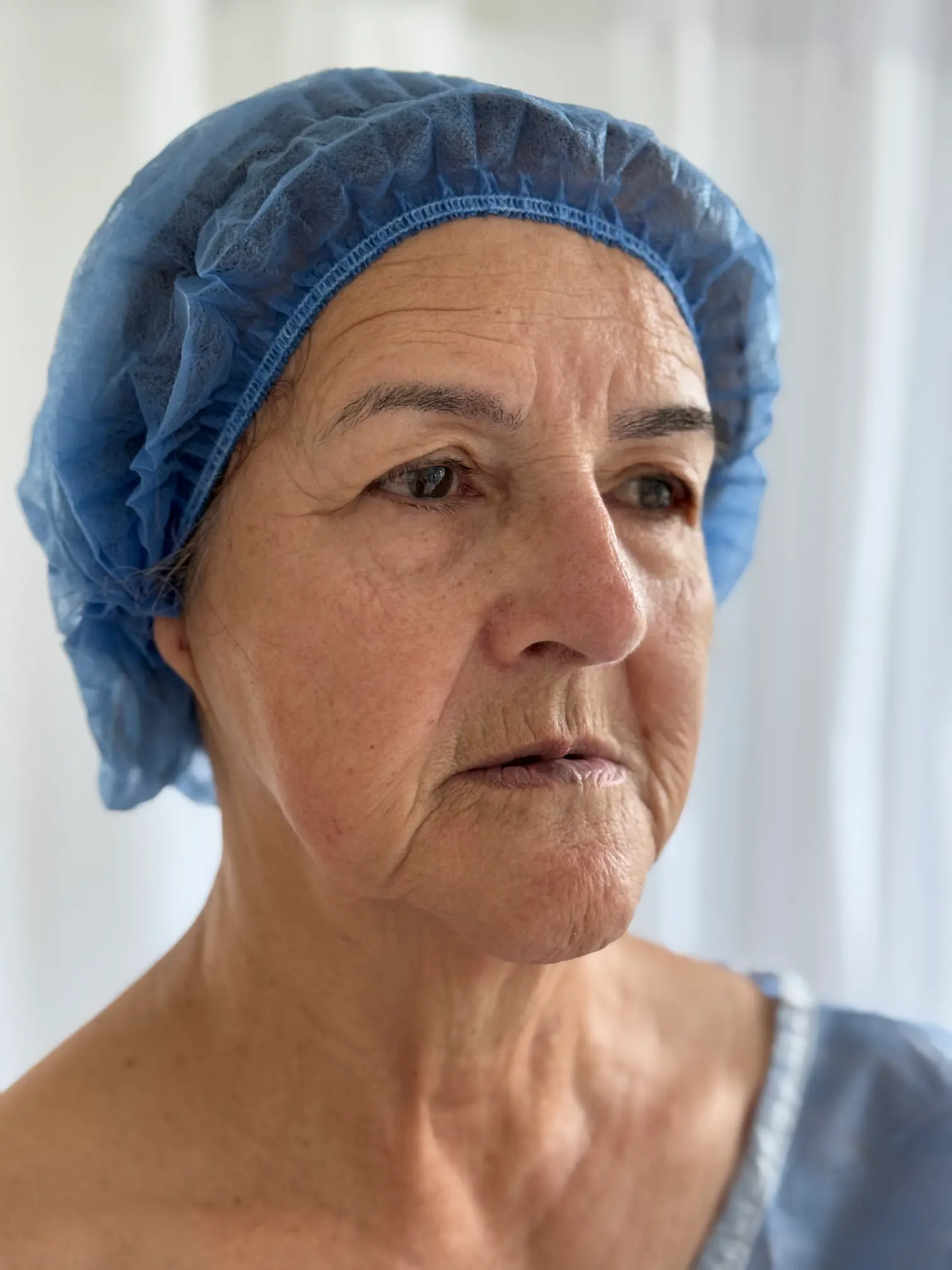 Párpados superiores e inferiores antes de cirugía de blefaroplastia - Dra. Daniela Correa - Medellín, Colombia