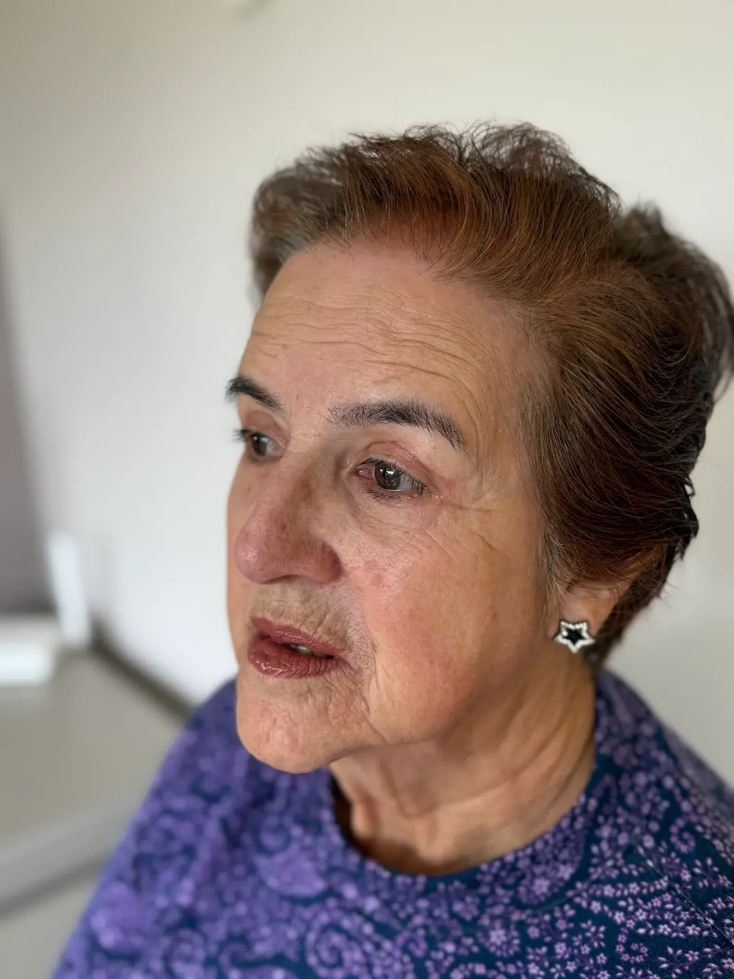 Resultado de blefaroplastia un año después de la cirugía de párpados - Dra. Daniela Correa - Medellín, Colombia