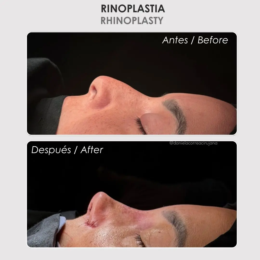 Rinoplastia antes y después - Cirujana plástica de Medellín colombia Daniela Correa - 020926